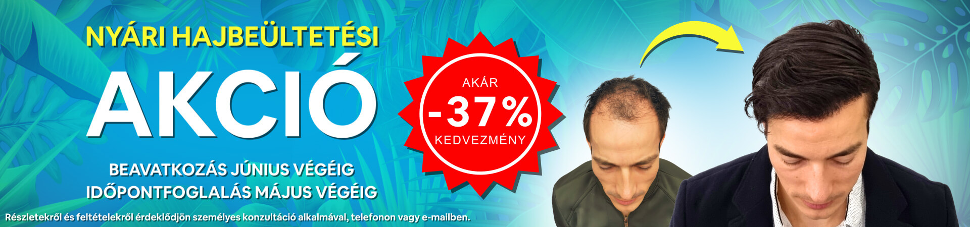 HIMG hajbeültetés akció