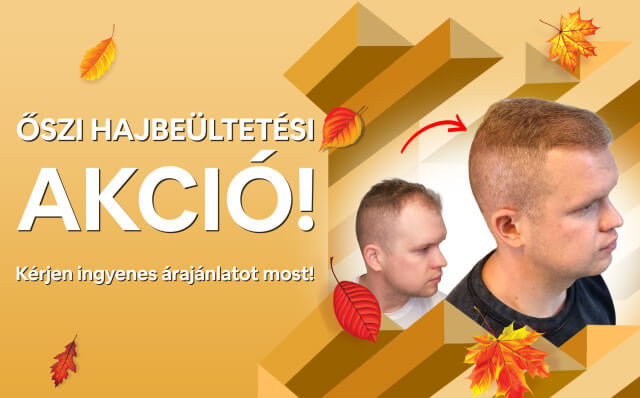 HIMG hajbeültetés akció HIMG hajbeültetés akció