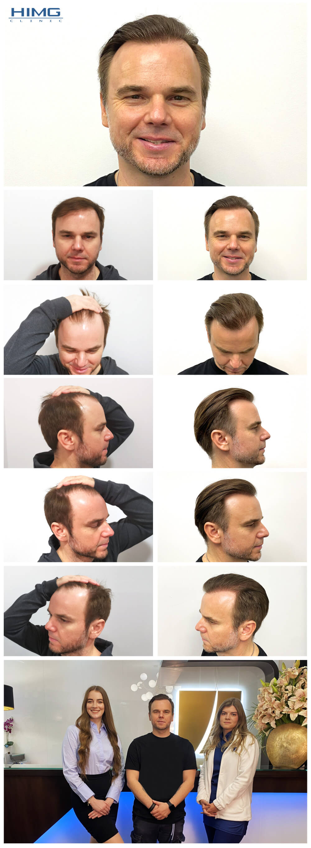 Juhász Gergely - hajbeültetés eredmény - előtte utána